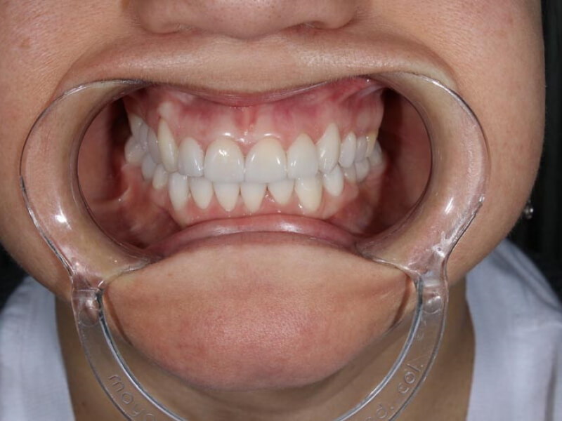 unilaser-implantes-dentales-caso-natalia-m-3-1