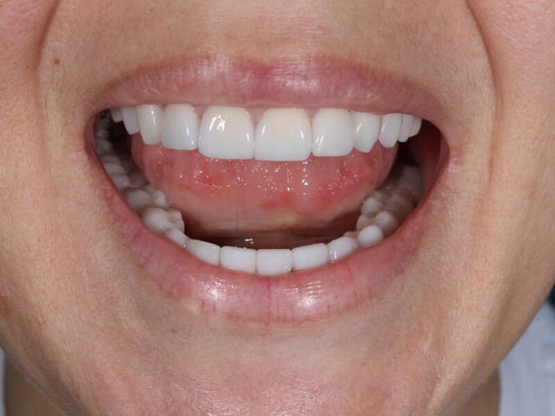 unilaser-implantes-dentales-caso-natalia-m-4-1