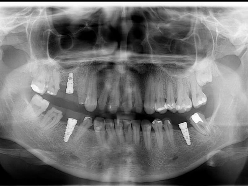 unilaser-implantes-dentales-caso-natalia-m-4