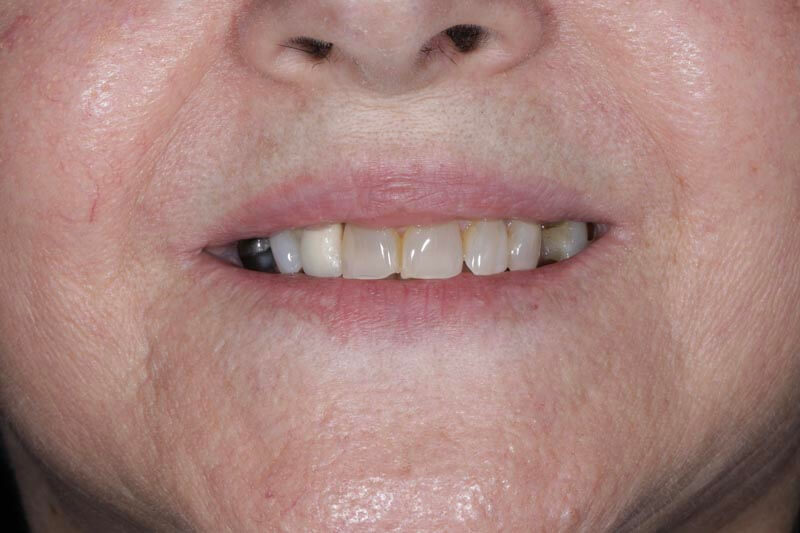 unilaser-implantes-dentales-caso-oliva-p-1
