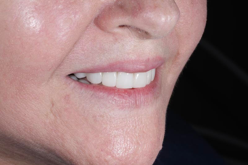 unilaser-implantes-dentales-caso-oliva-p-2-1