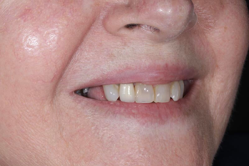 unilaser-implantes-dentales-caso-oliva-p-2-2