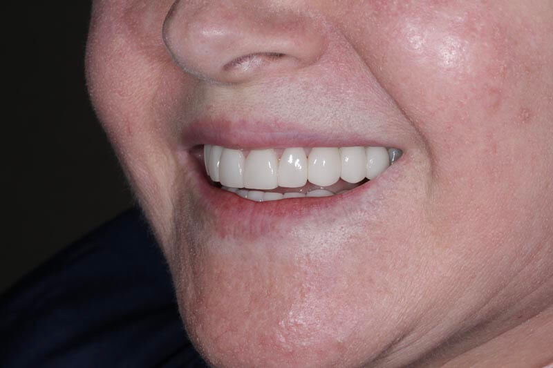 unilaser-implantes-dentales-caso-oliva-p-3-1