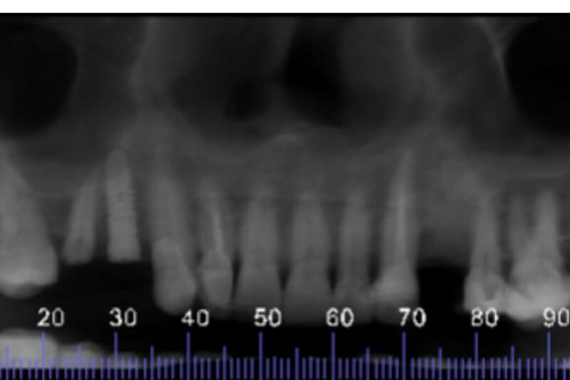unilaser-implantes-dentales-caso-oliva-p-3