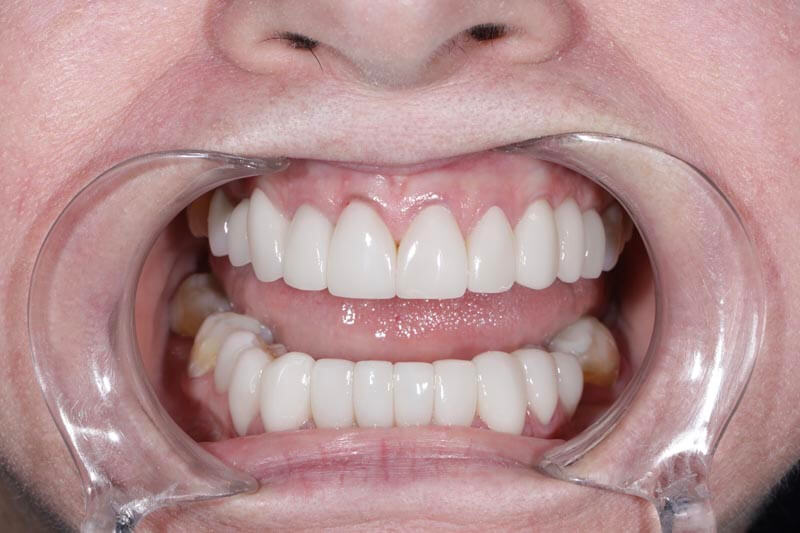 unilaser-implantes-dentales-caso-oliva-p-4-1