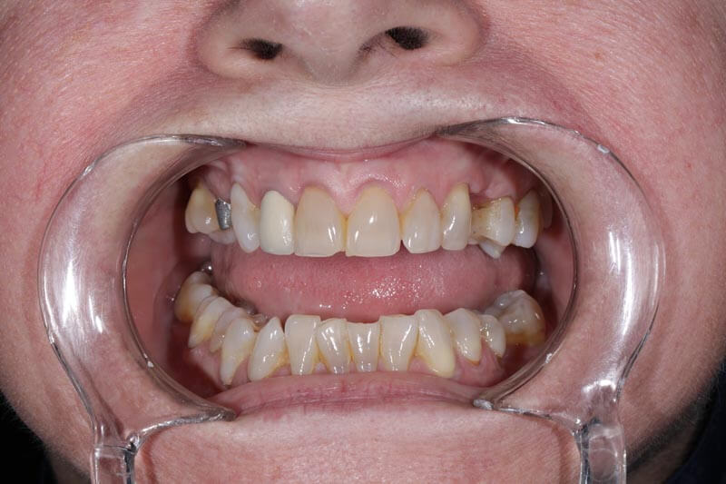 unilaser-implantes-dentales-caso-oliva-p-4