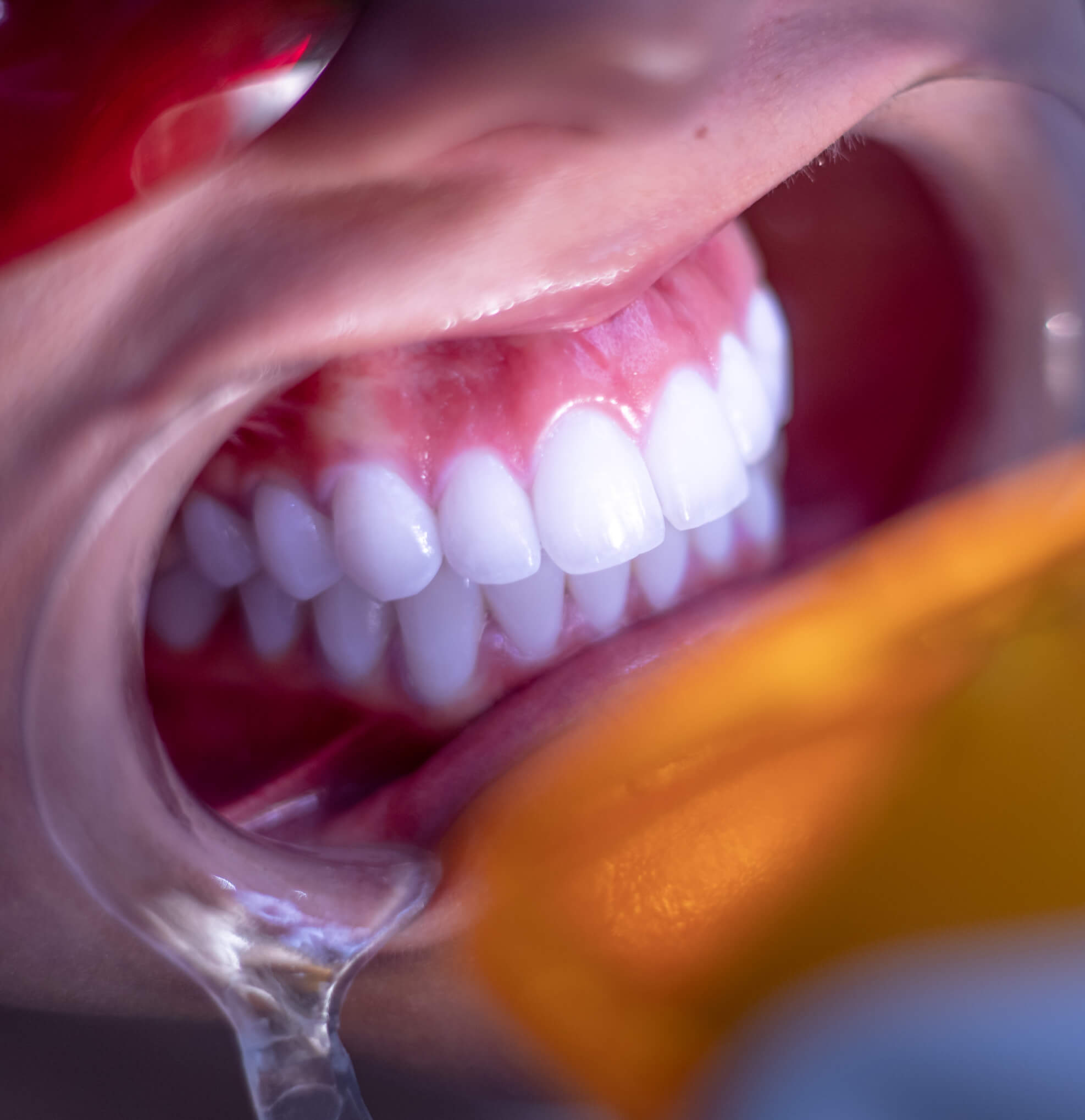 Blanqueamiento Dental en Medellín Unilaser