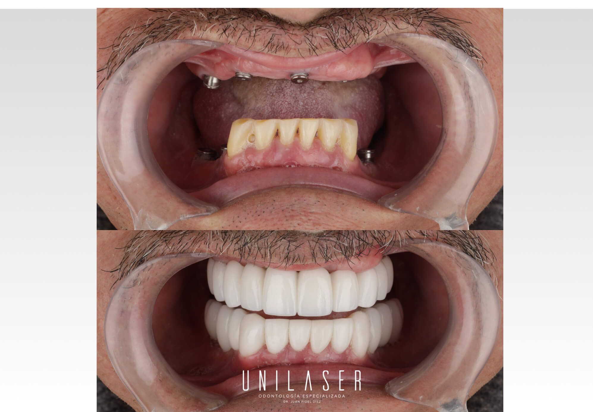 Implantes dentales en Medellín Unilaser