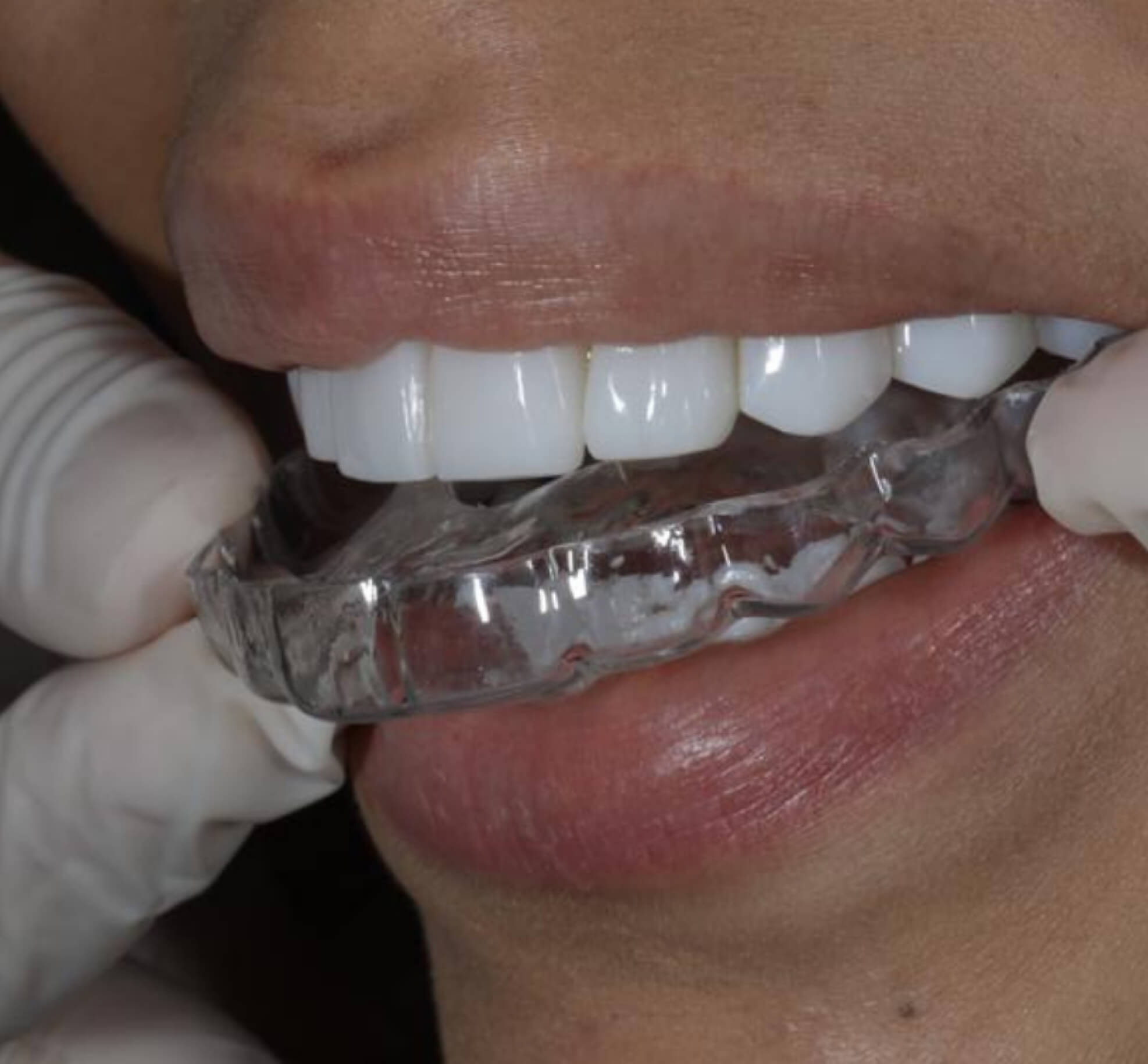 Tratamientos Odontológicos Estéticos - Ortodoncia Invisible
