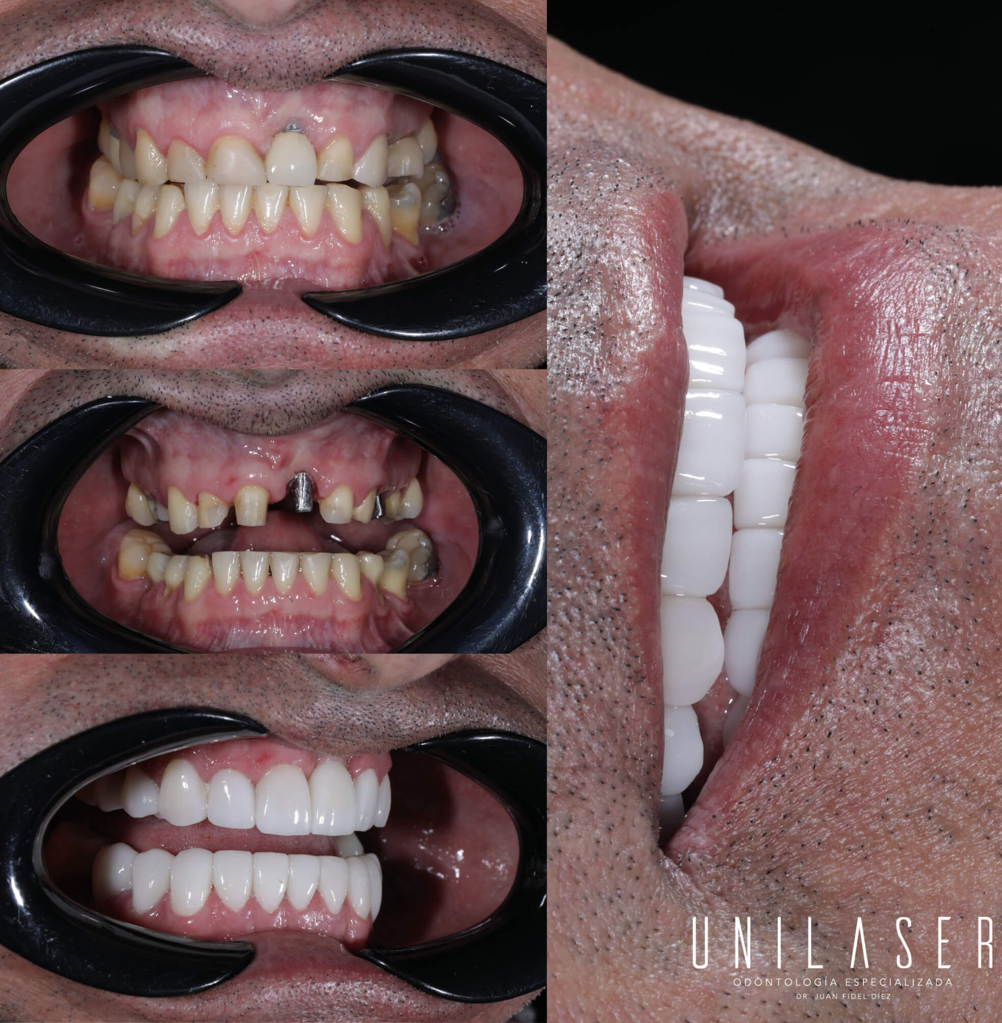 Tratamientos Odontológicos Estéticos - Rehabilitación Oral