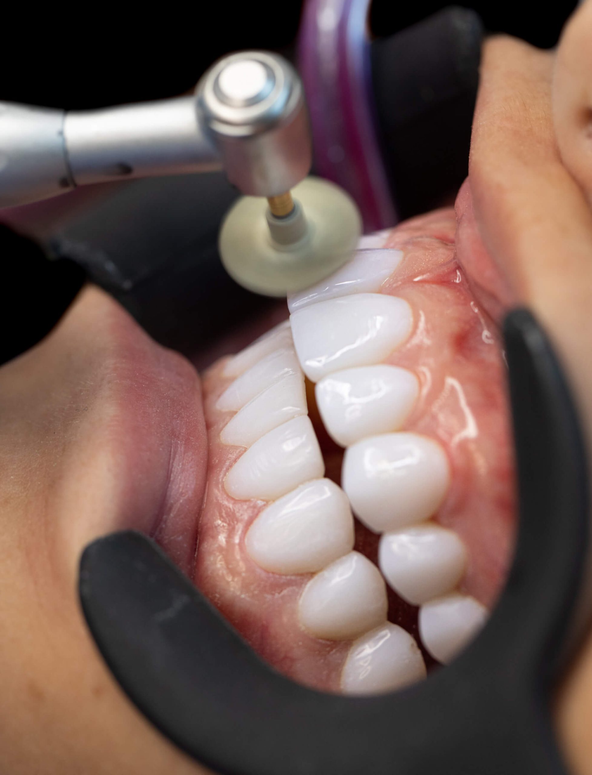 Carillas dentales en resina o composite -Bonding Venners