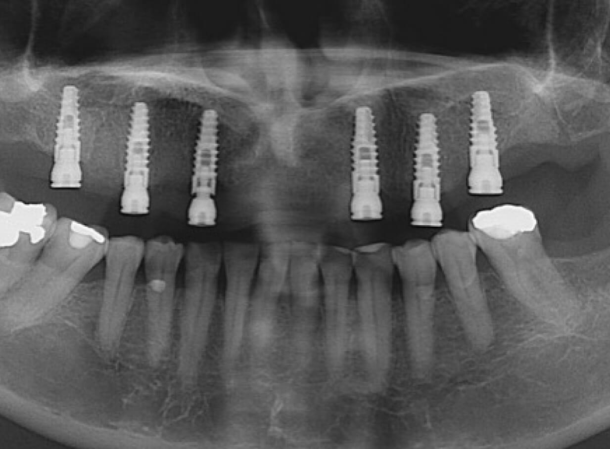 Implantes dentales en Medellín - Unilaser