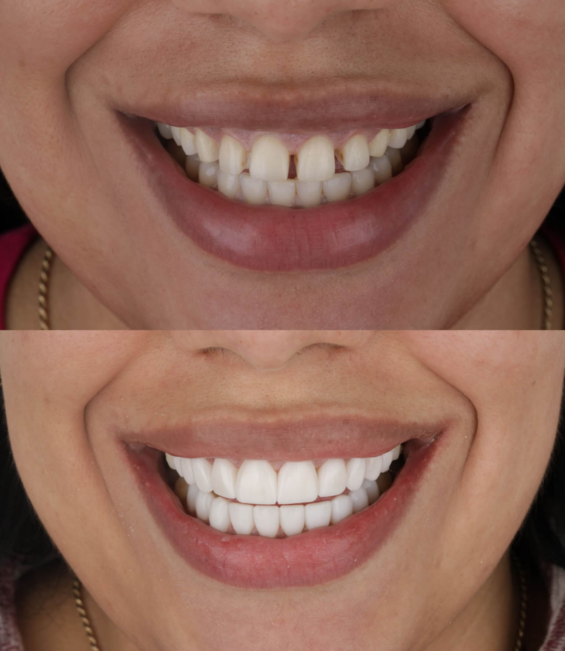 Diastema - Cierre de dientes separados o con espacios