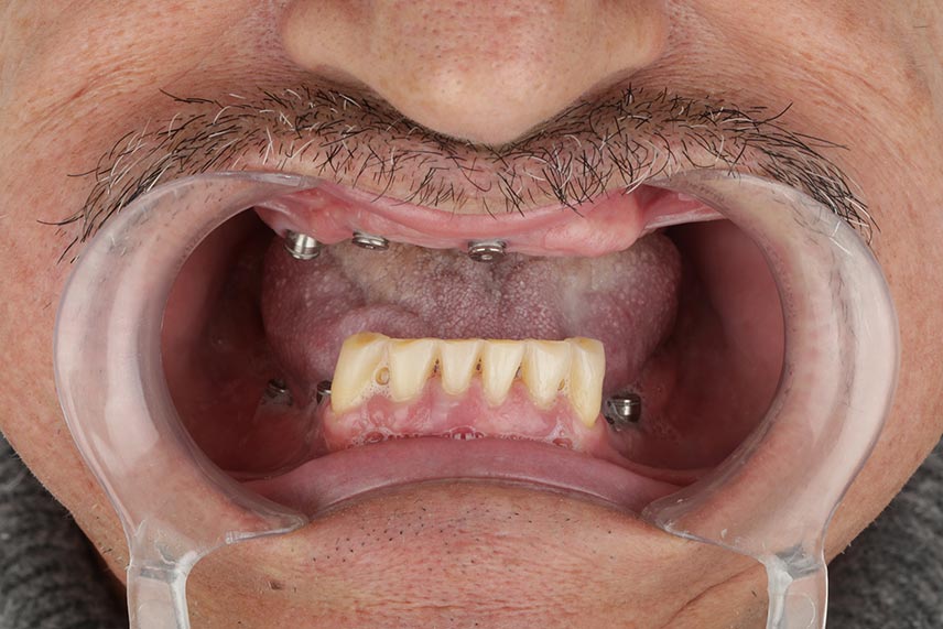 Importancia de los implantes dentales