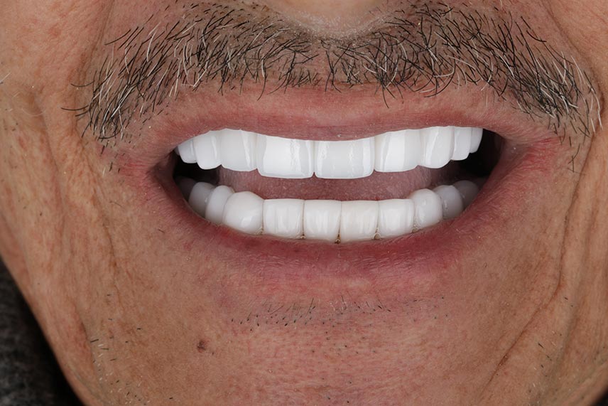 Mantenimiento implantes dentales