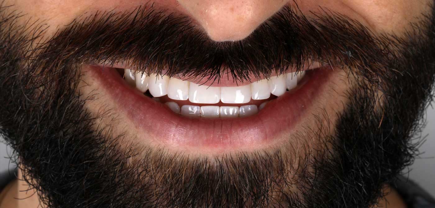 ¿What are bonding edges known as micro smile design?