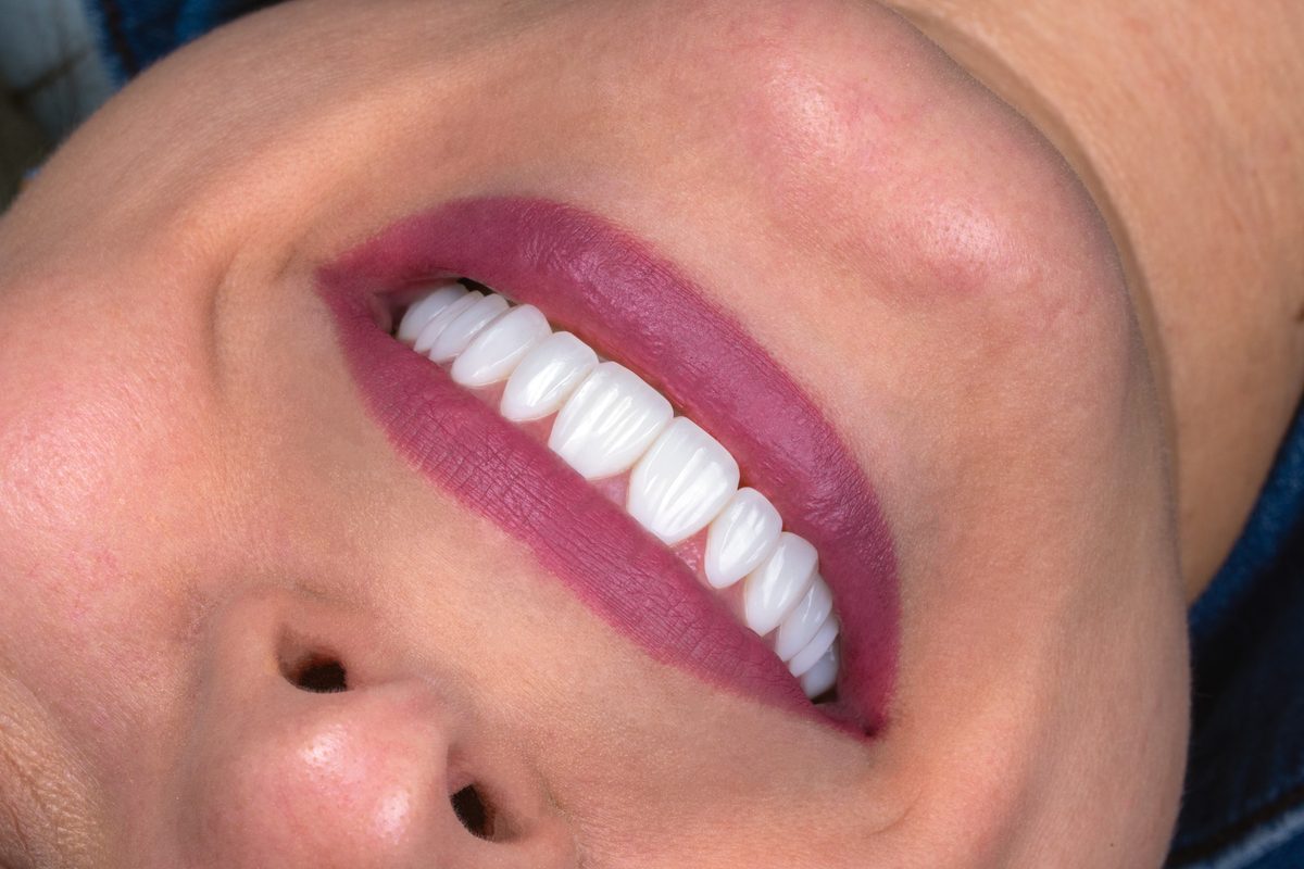 Cuánto dura un diseño de sonrisa con carillas de resina