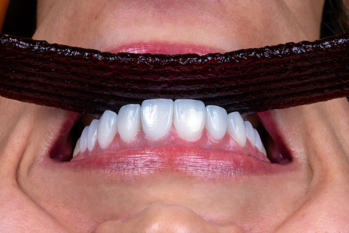 Cuánto dura un diseño de sonrisa – resultado final en Unilaser