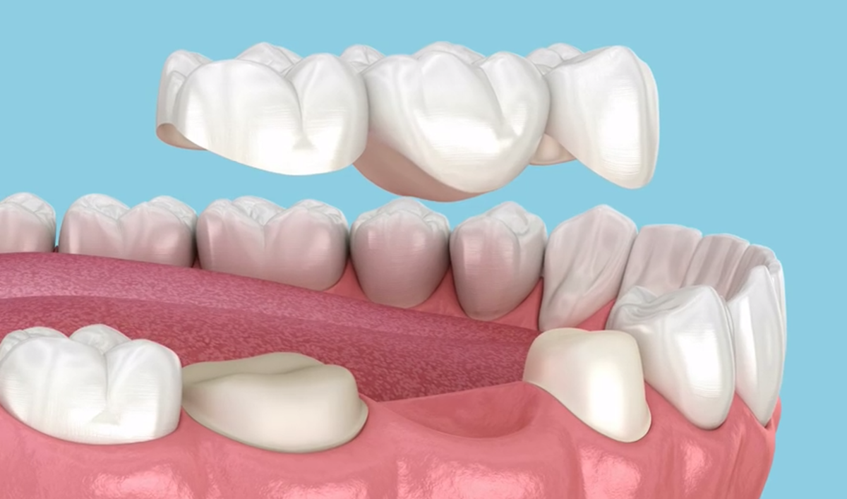 Modelo de puente dental en cantiléver o voladizo