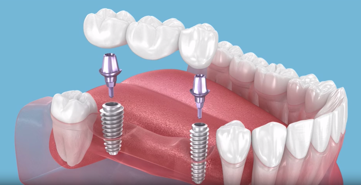 Modelo de puente dental sobre implantes