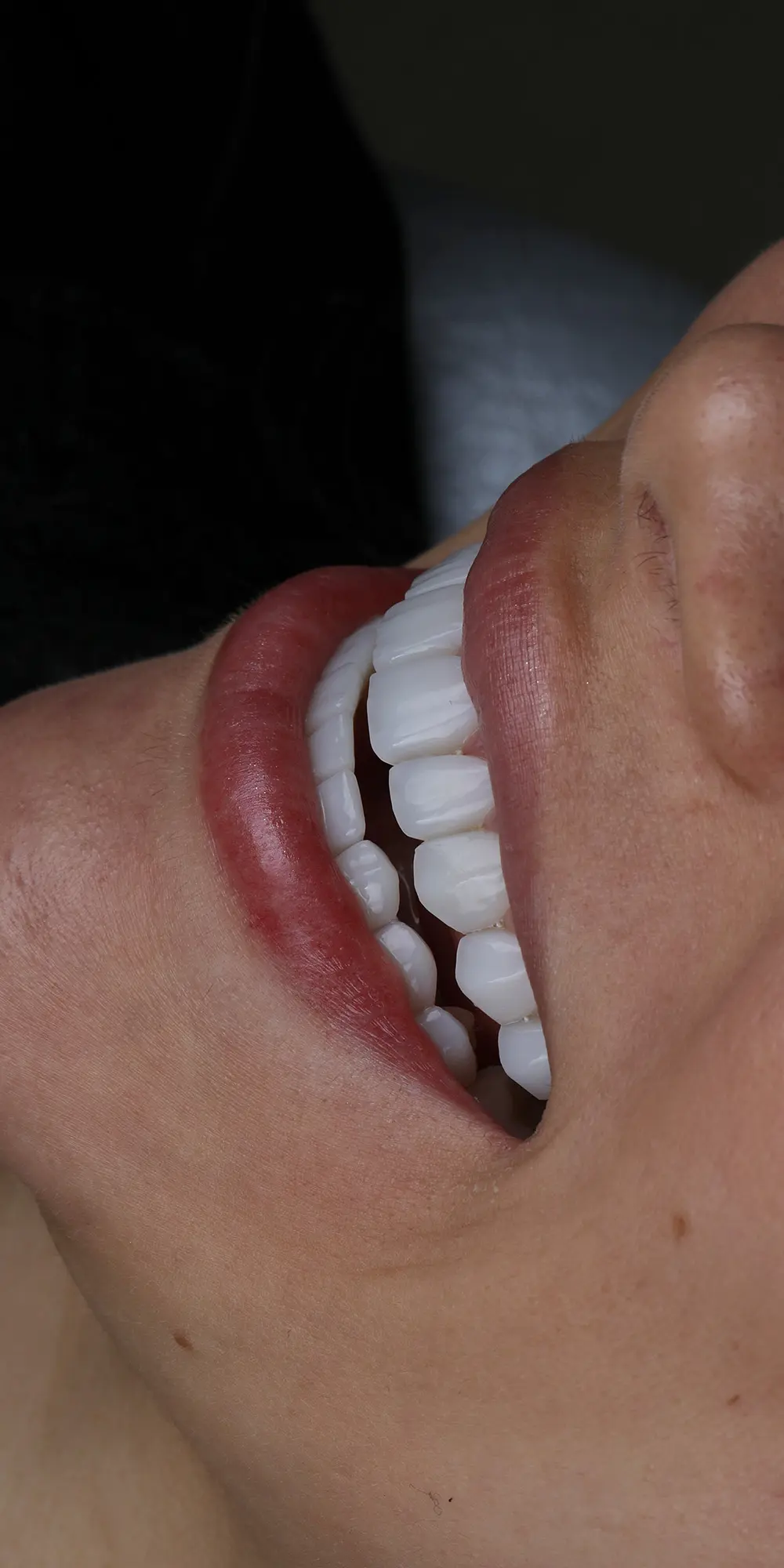 Tratamientos Odontológicos Estéticos - Diseño de Sonrisa