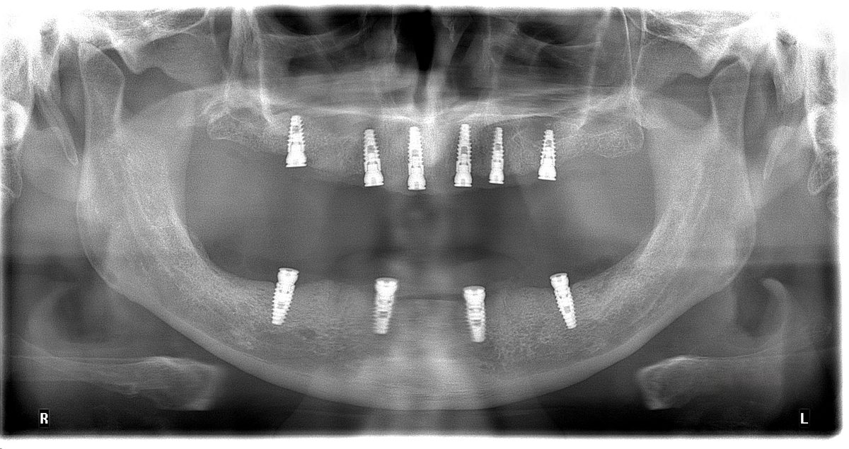 Radiografía de implantes dentales integrados en un caso real de Unilaser