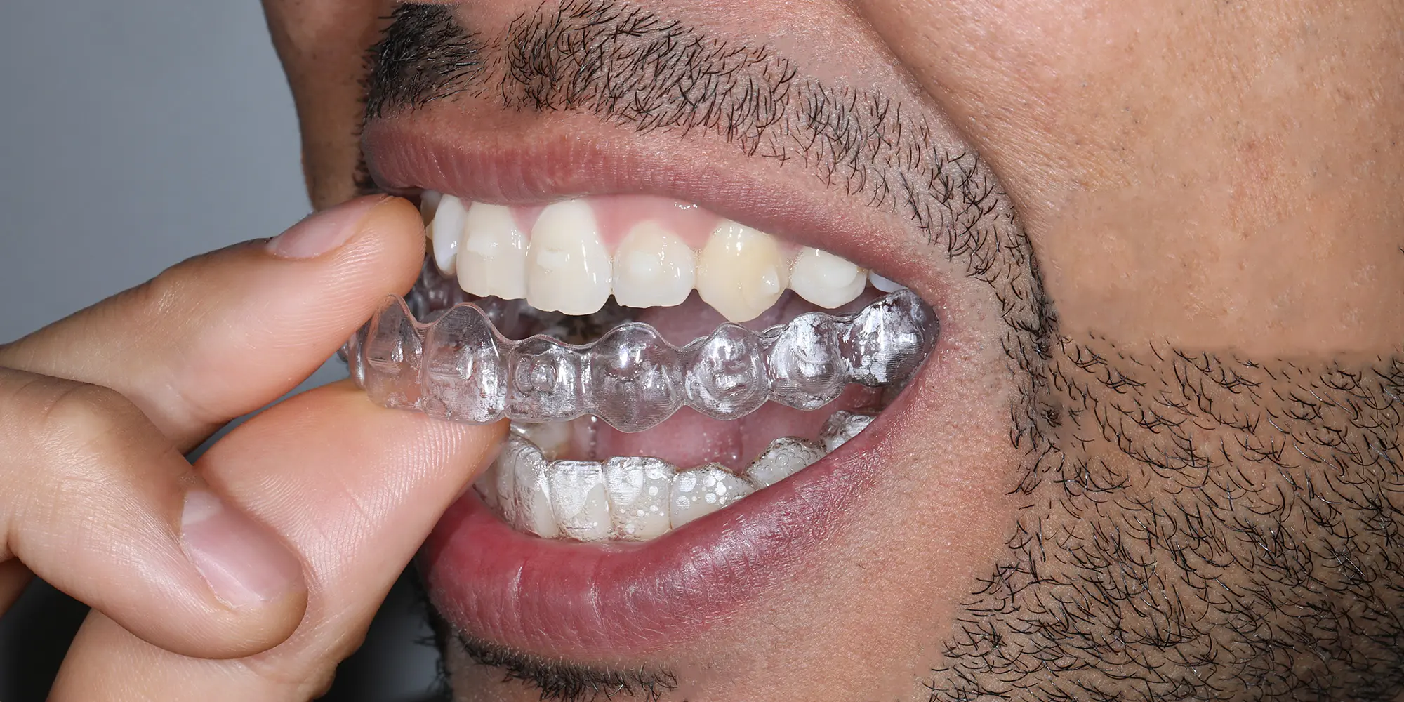 Tratamientos Odontológicos Estéticos - Ortodoncia Invisible