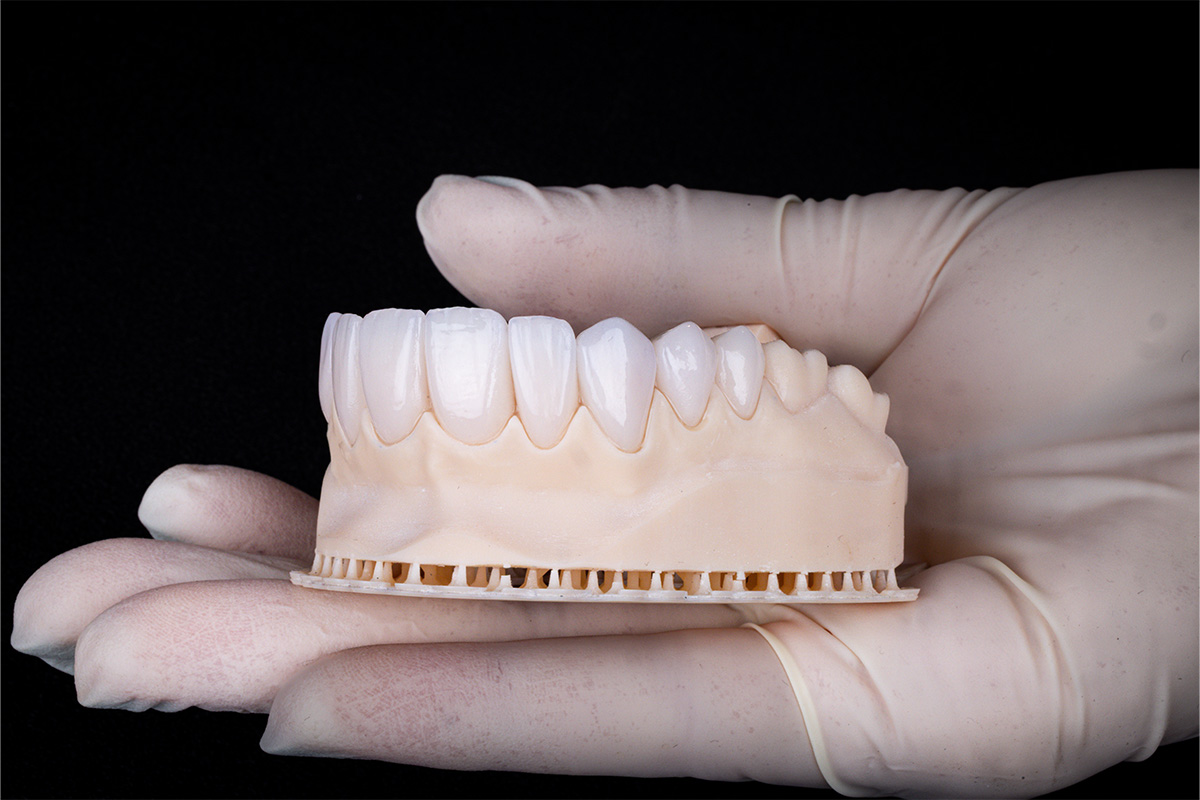 Modelo de carillas dentales para diseño de sonrisa en Unilaser