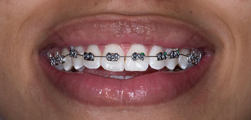 Brackets tradicionales