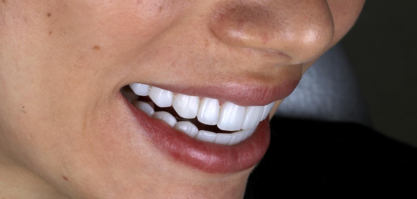 Durabilidad de un diseño de sonrisa