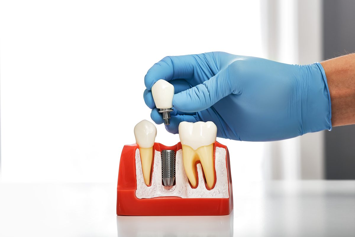 Modelo de implante dental, base del tratamiento para candidato a implantes dentales
