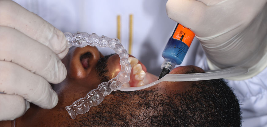 Desventajas de los brackets invisibles