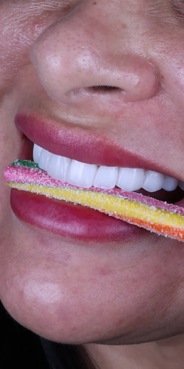 Carillas dentales en resina o composite -Bonding Venners