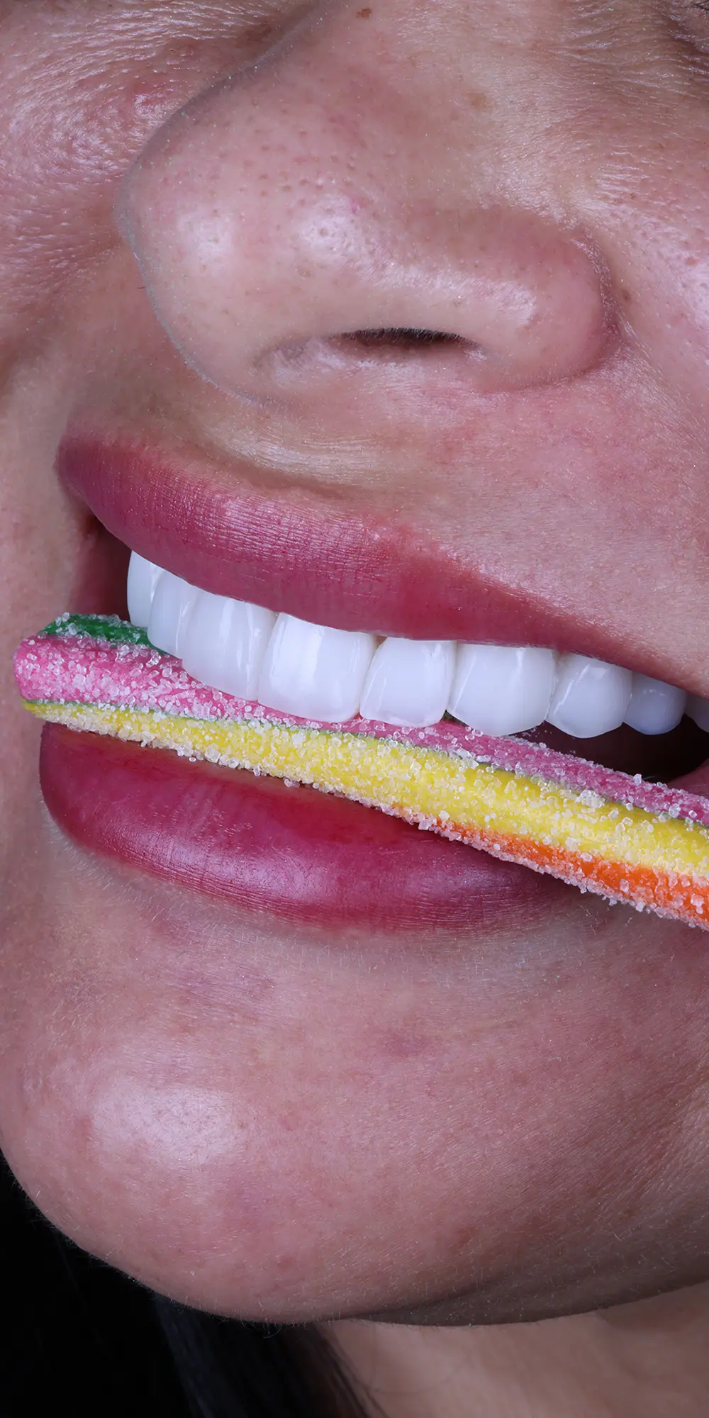 Carillas dentales en resina o composite -Bonding Venners