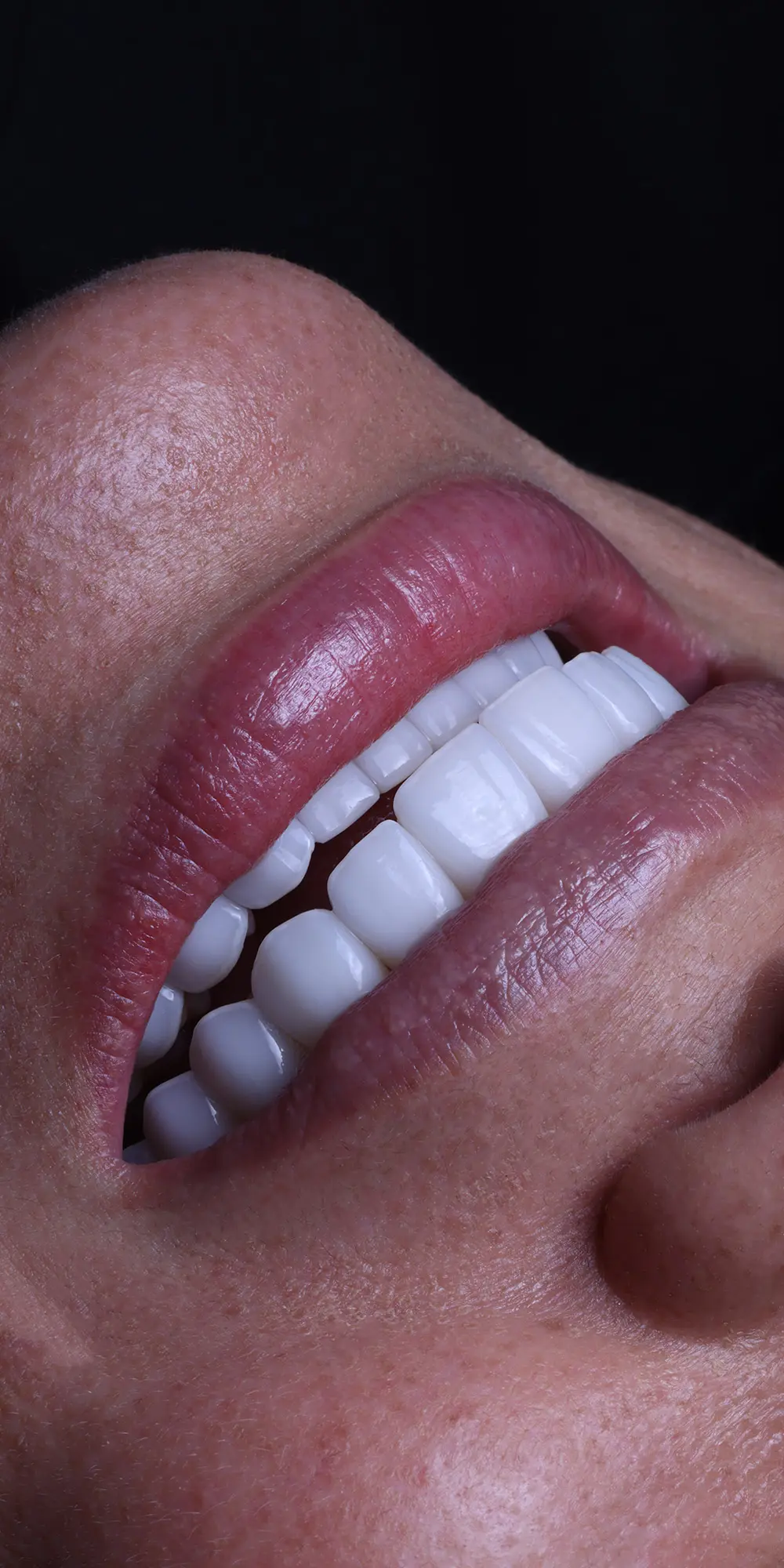 Carillas dentales en porcelana Porcelain Veneers