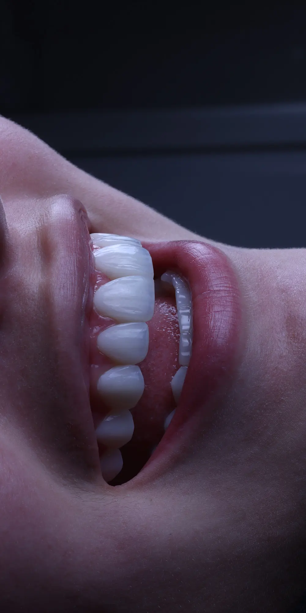 ¿Qué materiales se usan para realizar un diseño de sonrisa?