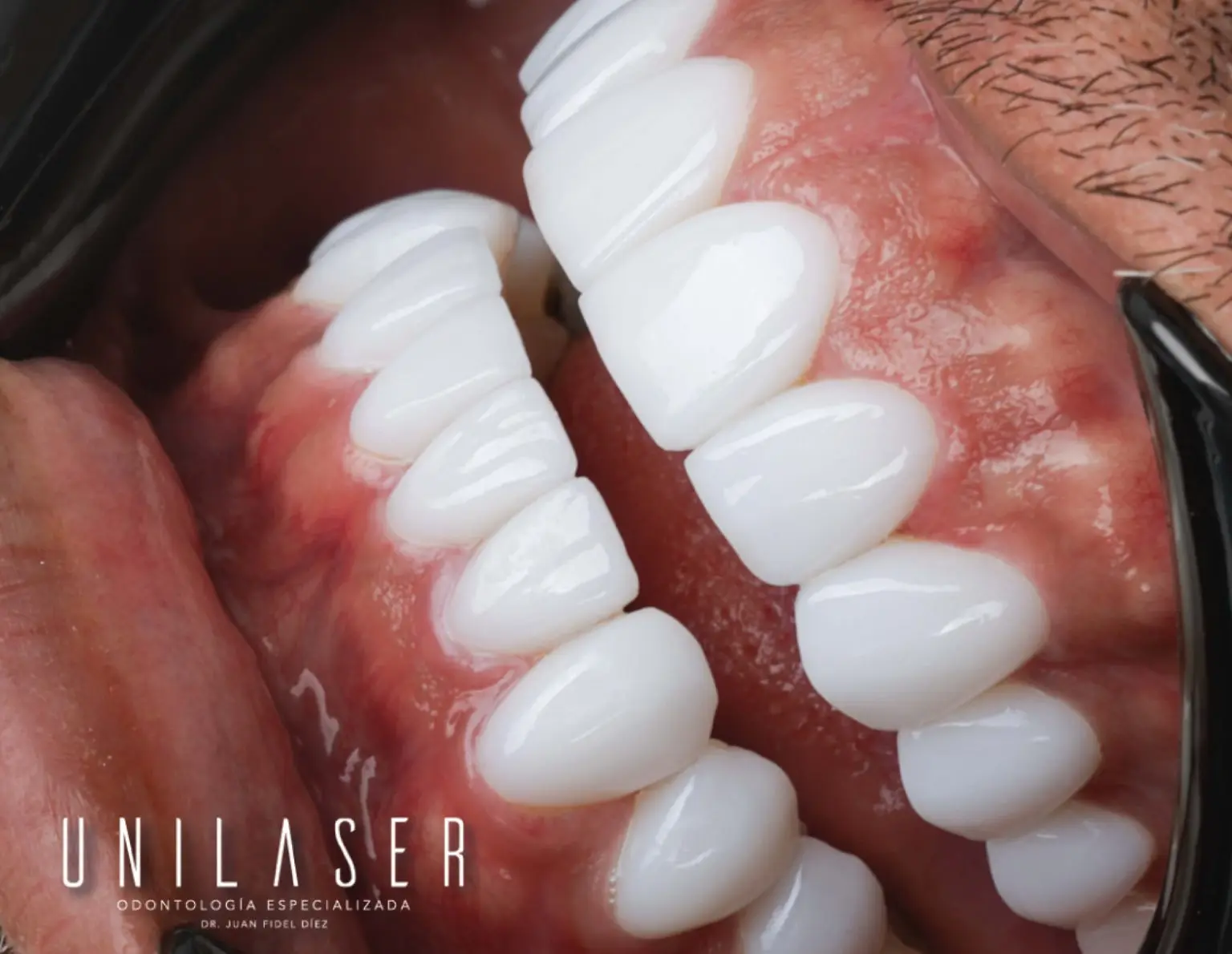 Especialistas en Endodoncia en Medellín Unilaser