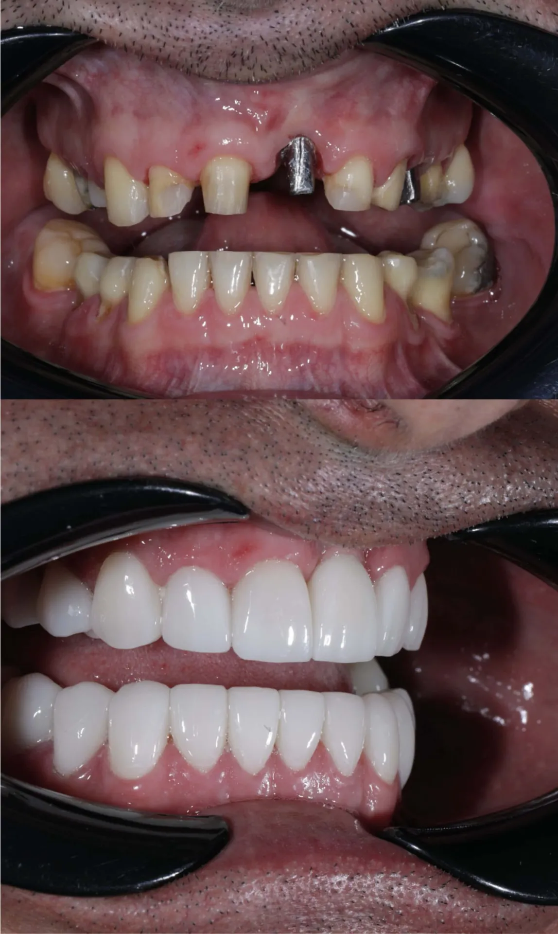 ¿Cómo se hace la rehabilitación oral en Medellín?