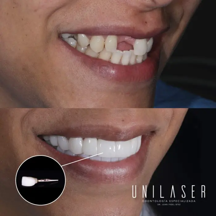 Diagnóstico dental Virtual Unilaser Medellín