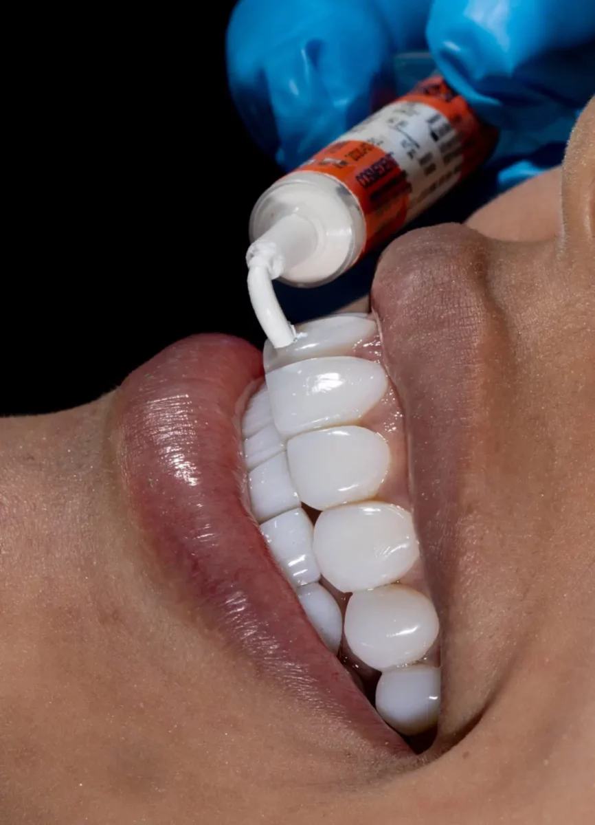 Síntomas de la periodontitis