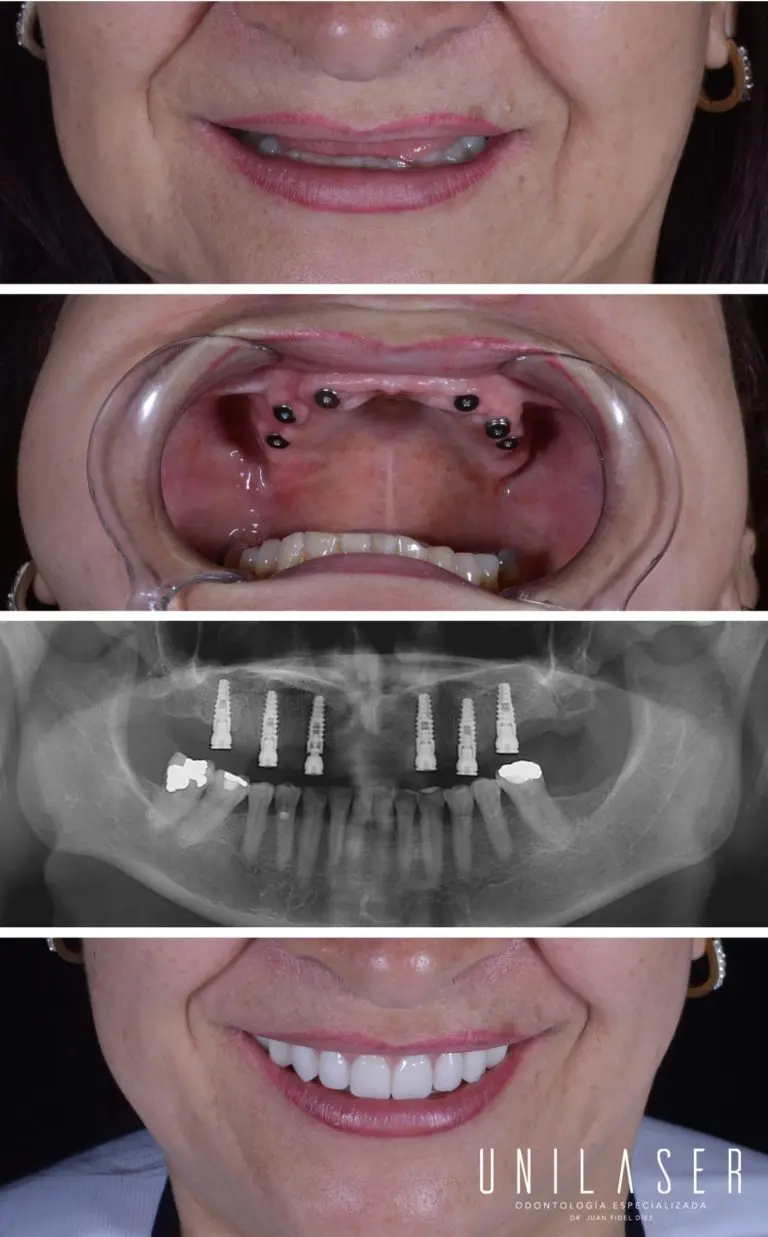 Beneficios de los implantes dentales