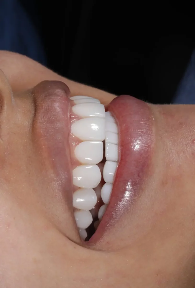 Tratamientos para la periodontitis