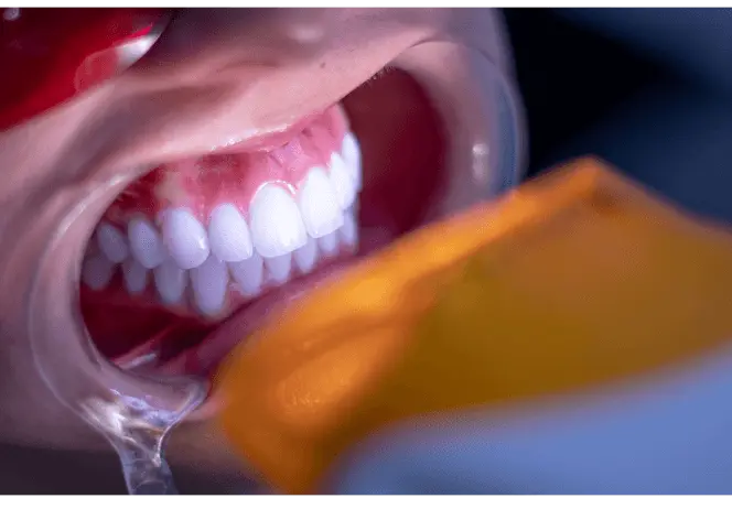 Blanqueamiento dental en Medellín