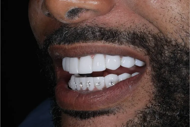 Tratamientos Odontológicos Estéticos - Endodoncia