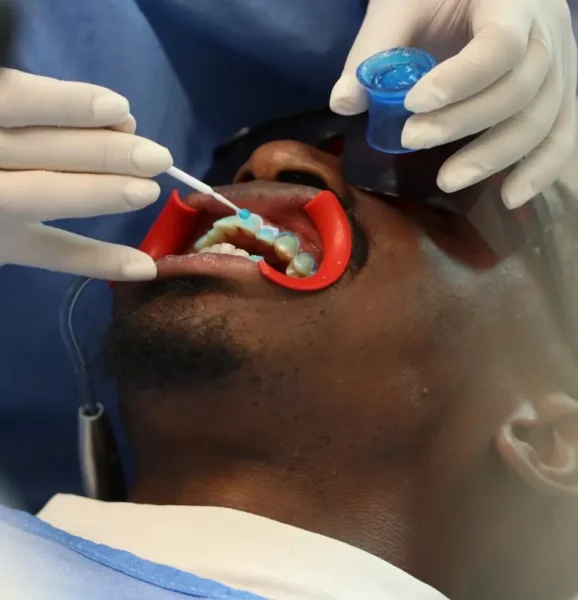 Blanqueamiento dental combinado Medellín Colombia Unilaser