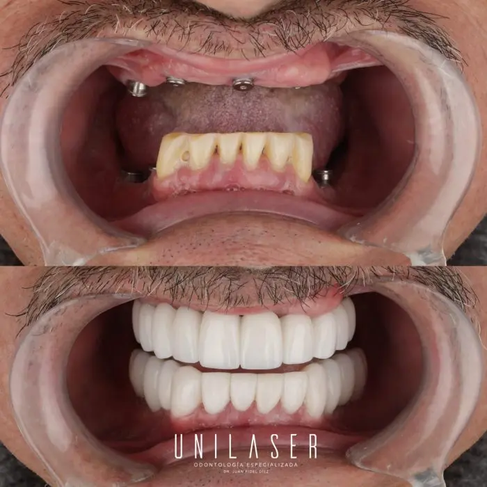 Tratamientos Odontológicos Estéticos - Implantes Dentales