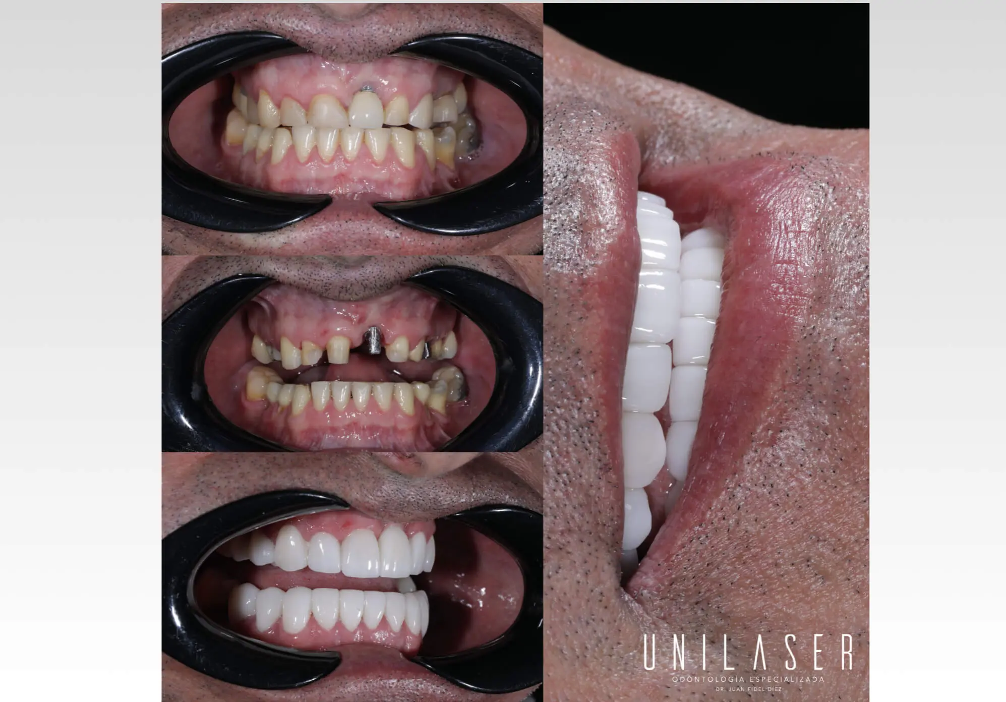 Rehabilitación oral en Medellín