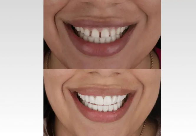 Cierre de espacios dentales o Dientes Separados en Medellín Unilaser