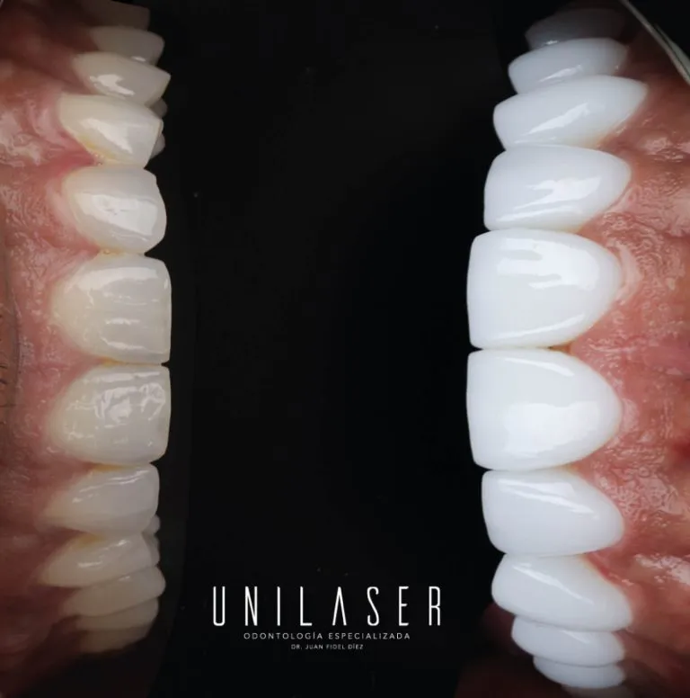 Consecuencias de la enfermedad periodontal