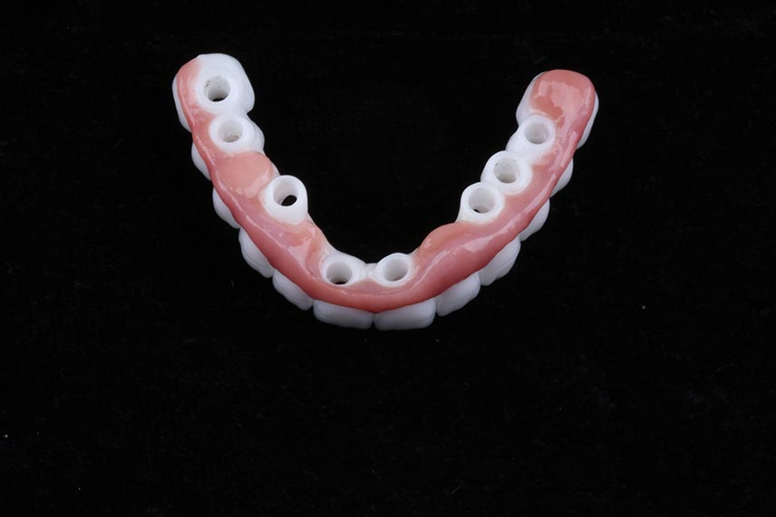 Implantes dentales BioHorizon Straumann